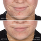 Before and after photographs of a woman's chin and jawline after 7 days using Medik8 Niacinamide Peptides, showing visibly clearer skin.