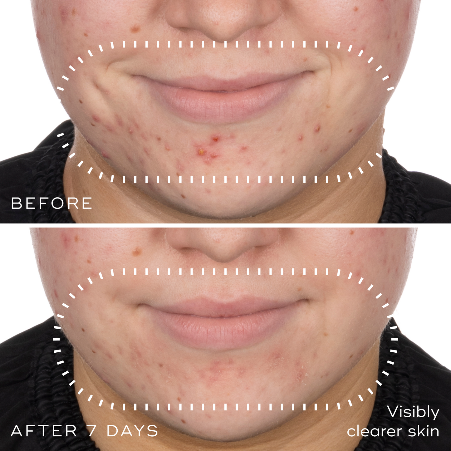 Before and after photographs of a woman's chin and jawline after 7 days using Medik8 Niacinamide Peptides, showing visibly clearer skin.