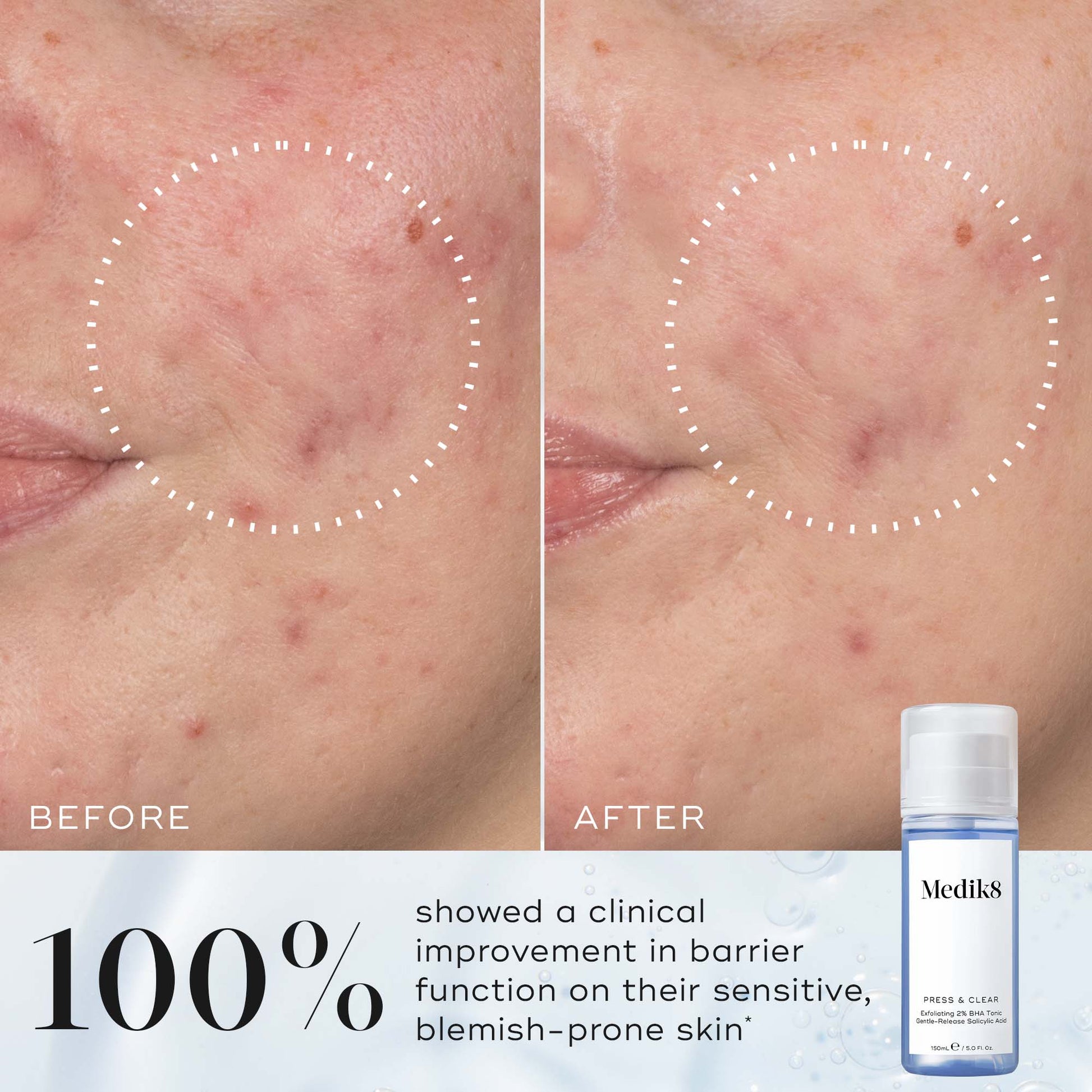 Medik8 Press & Clear before and after results on blemish-prone skin