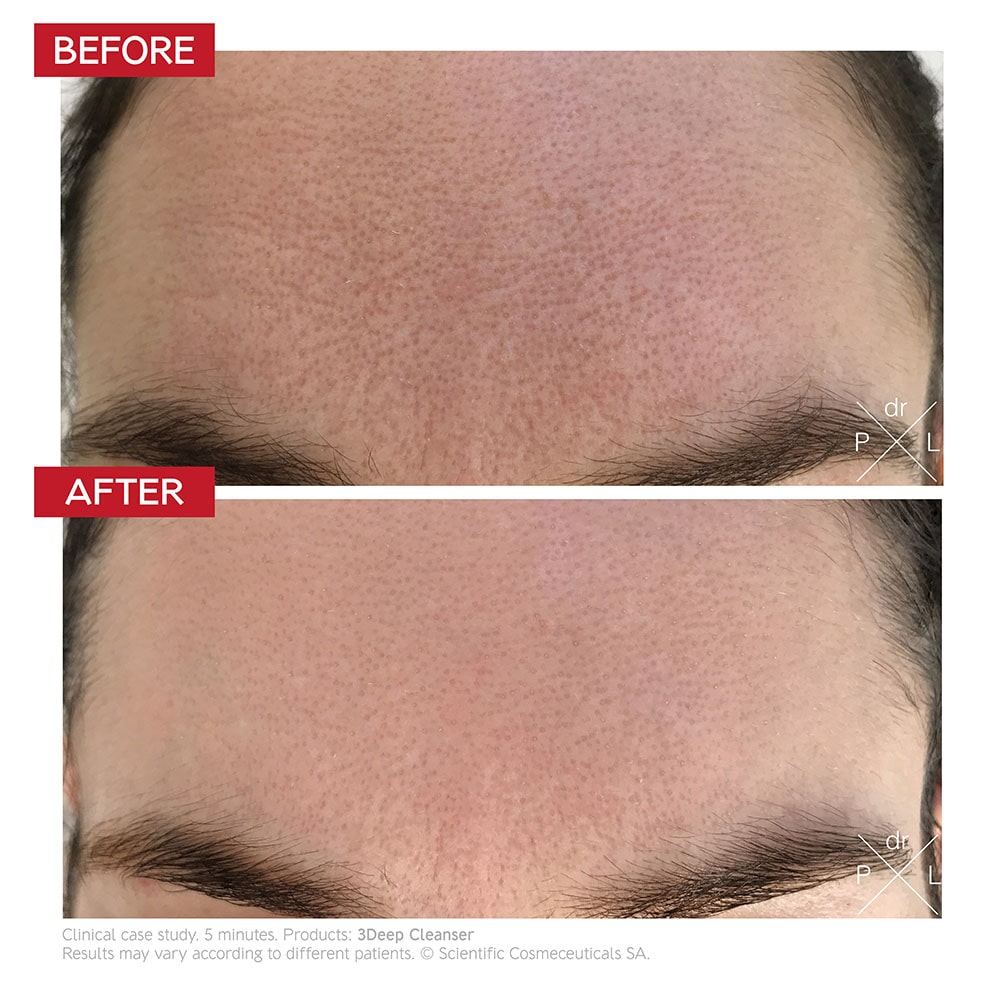 Dr Levy 3Deep Cleanser 150ml - before and after results